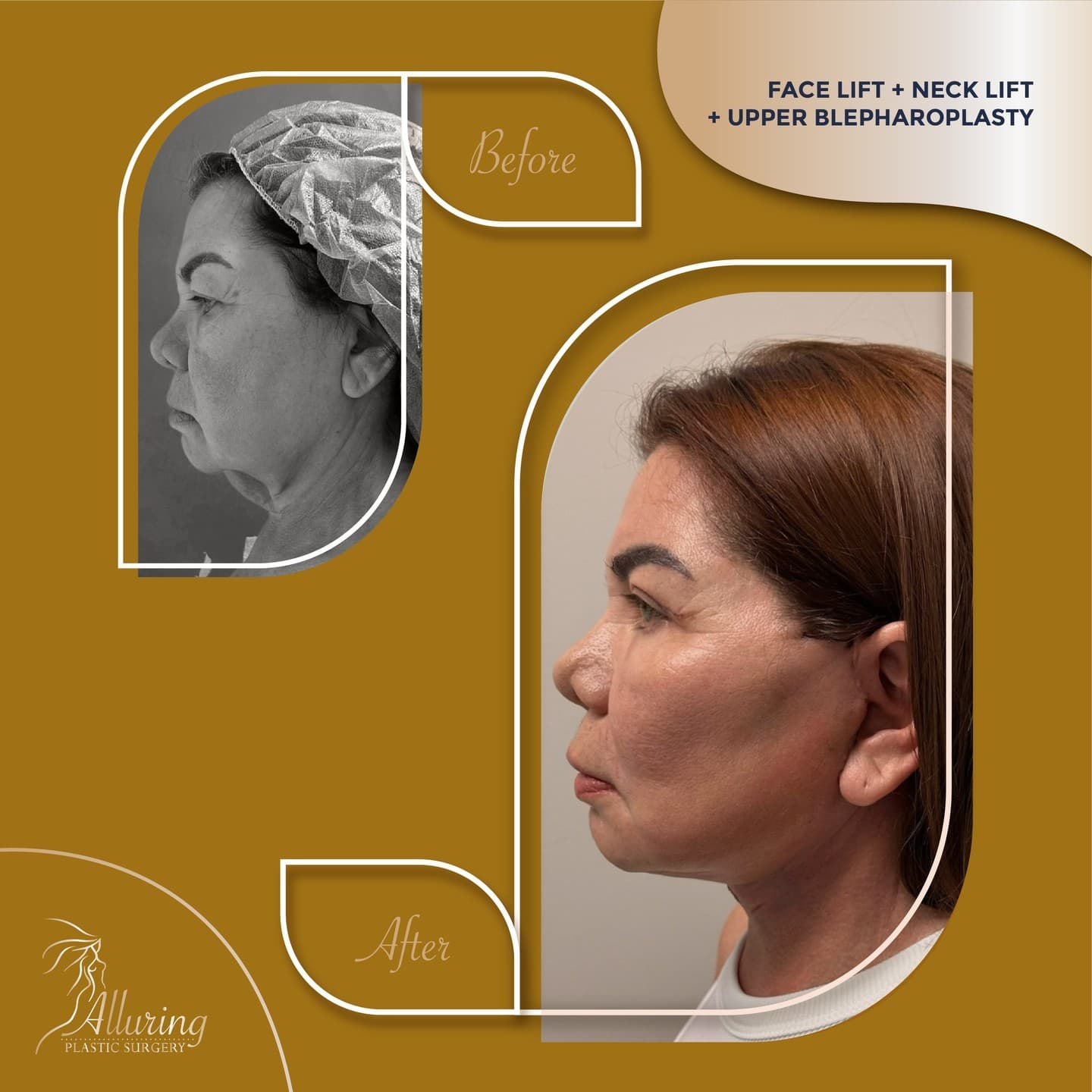 ✨ Transformative Results: A Journey to Youthfulness ✨

Check out these stunning results from a combi