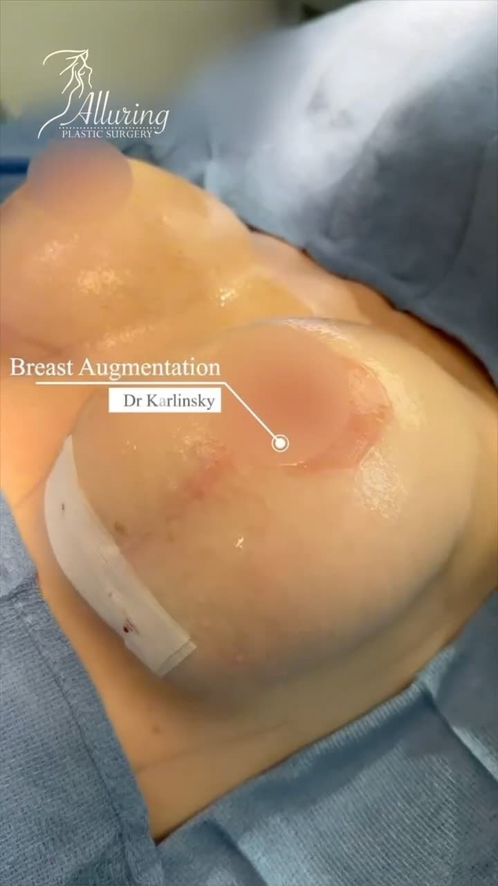 ✨ Unleash Your Confidence ✨

Take a look at this amazing  breast augmentation. 🌟 This procedure enh