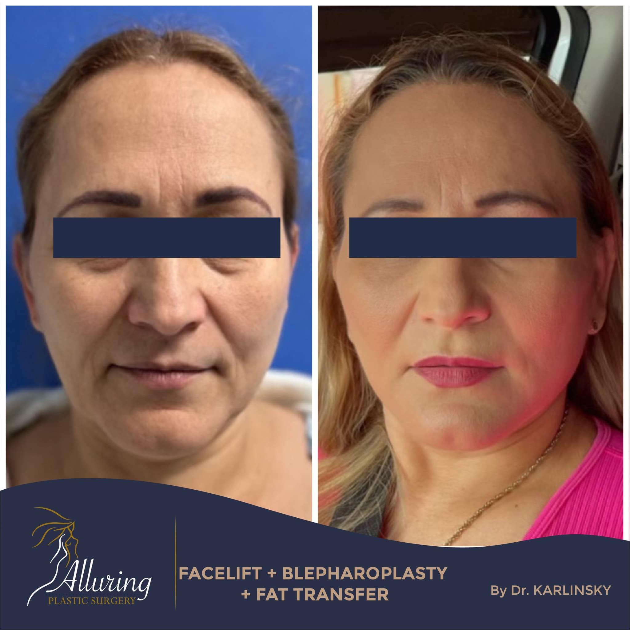 Side-by-side before and after images of a woman showing facial rejuvenation with facelift, eyelid surgery, and fat transfer, demonstrating smoother skin and more youthful facial contours