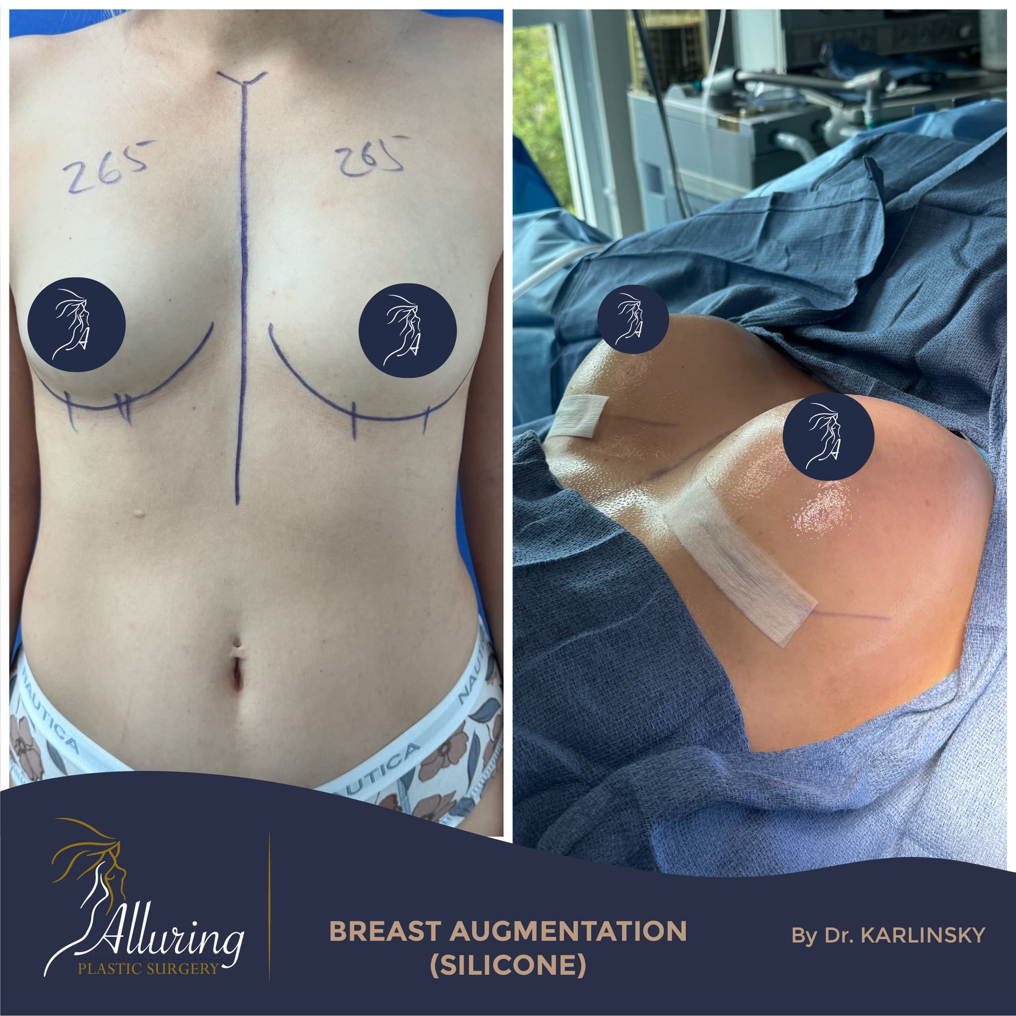 Enhanced Silhouette by Dr. Karlinsky ✨
A fuller look and renewed confidence! 💬 DM us or call for a 