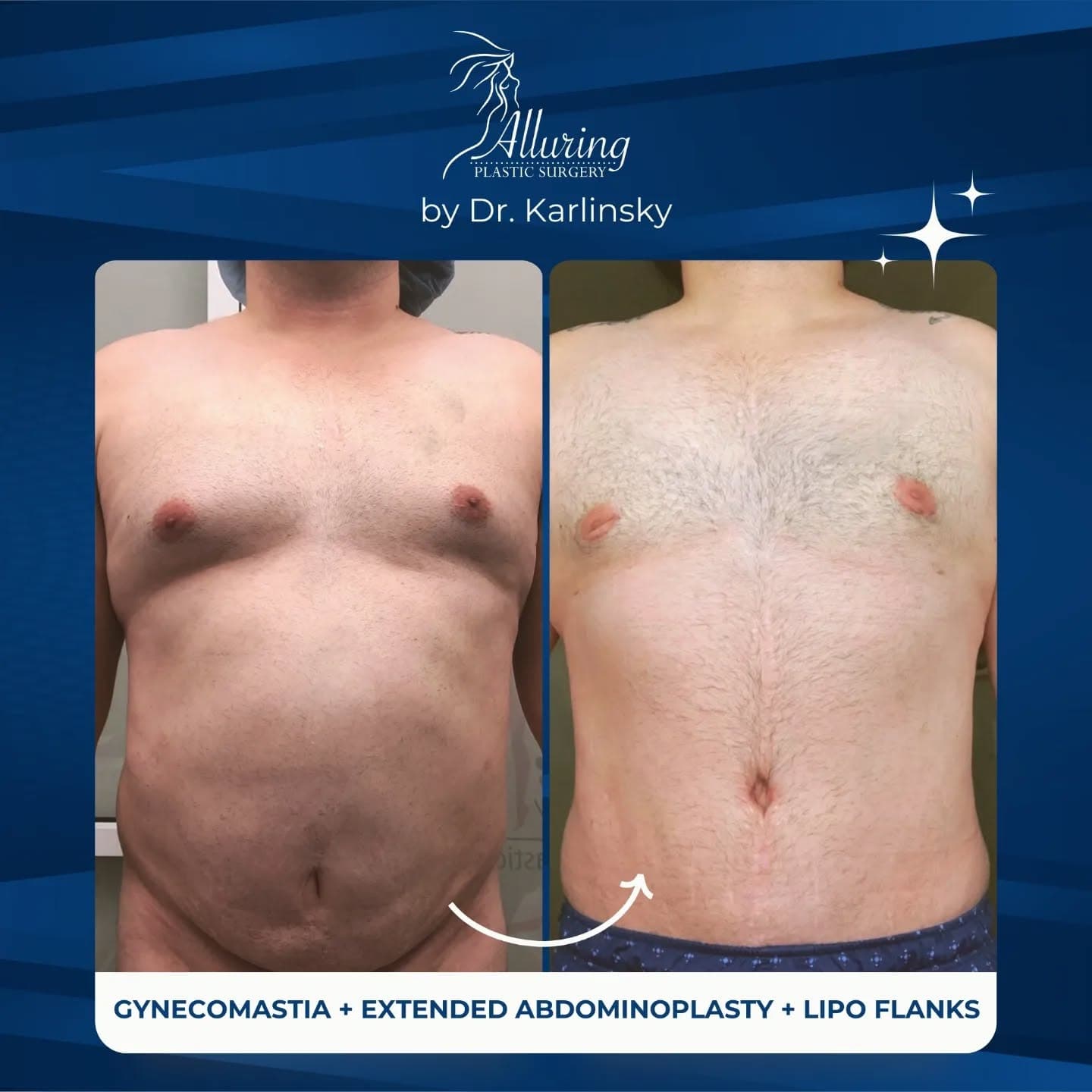 Incredible results with gynecomastia and extended tummy tuck. 💪

Check out how we’ve helped our pat