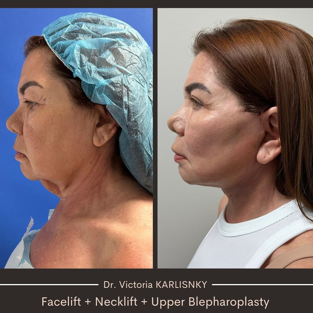 Aging gracefully is beautiful, but sometimes a little refresh can make all the difference! 💖 This p