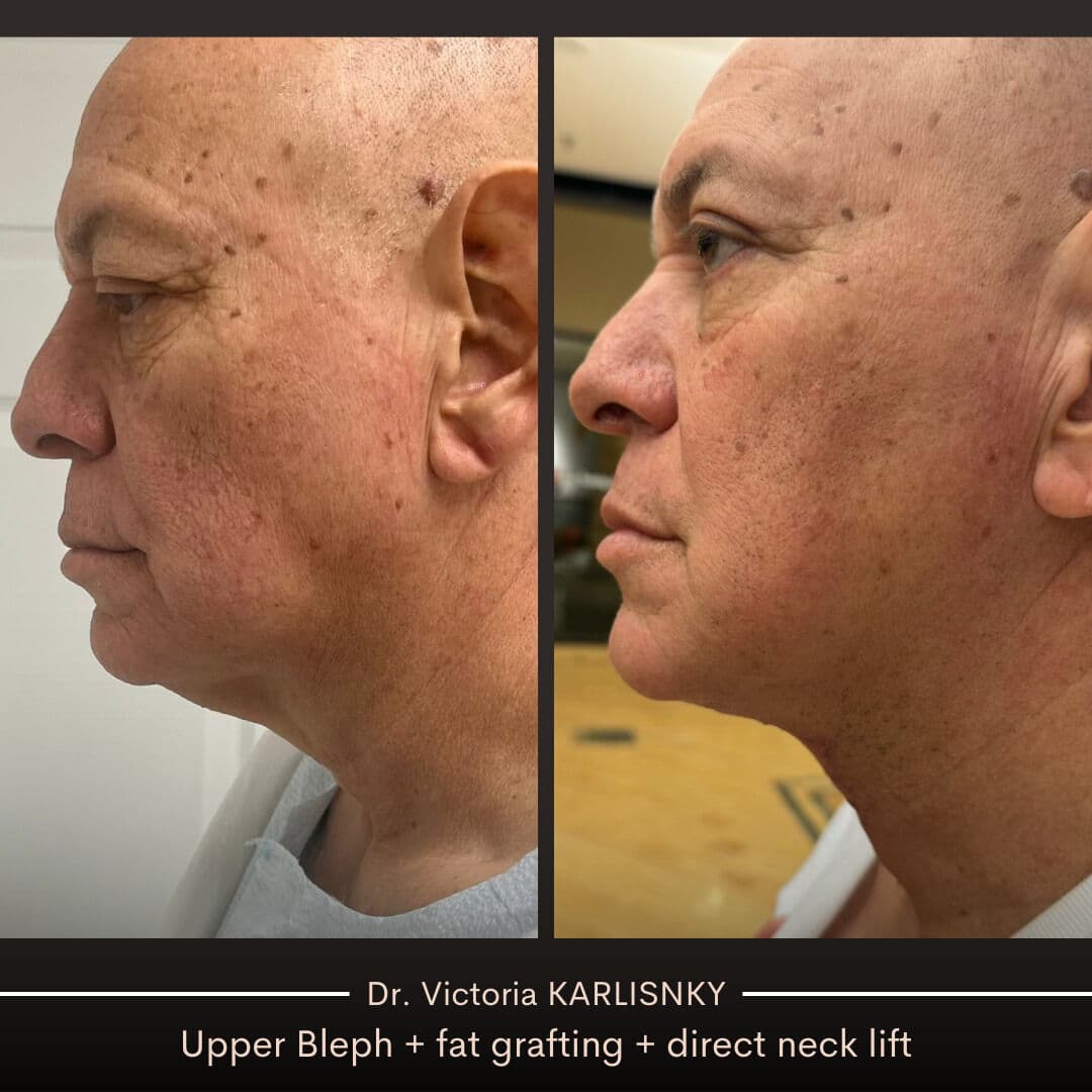 ✨ A refreshed, natural look — without losing his essence.
This male patient underwent:
✔️ Upper blep