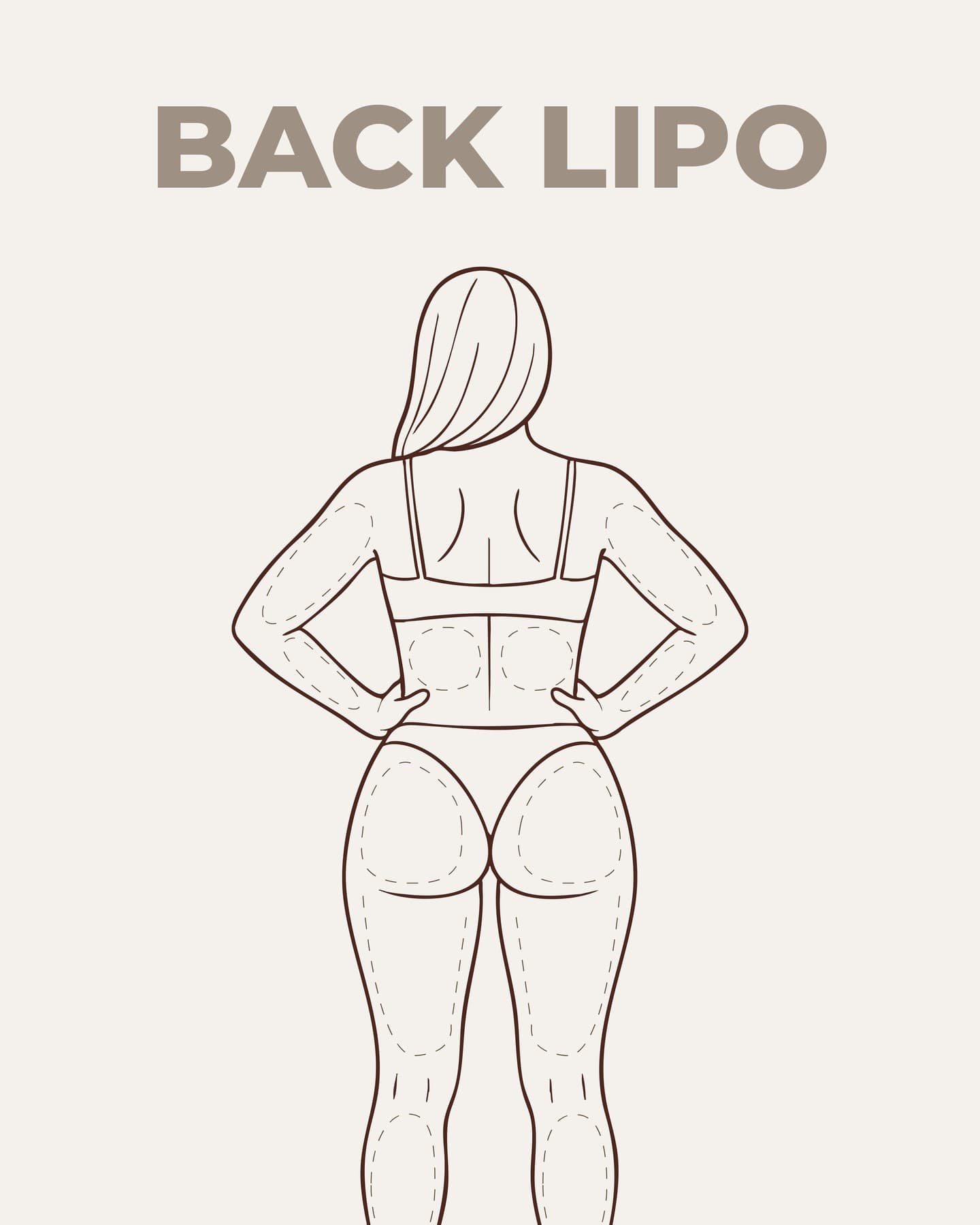 Illustration showing back view of a female body with highlighted zones for liposuction, including upper and lower back, arms, flanks, buttocks, and thighs