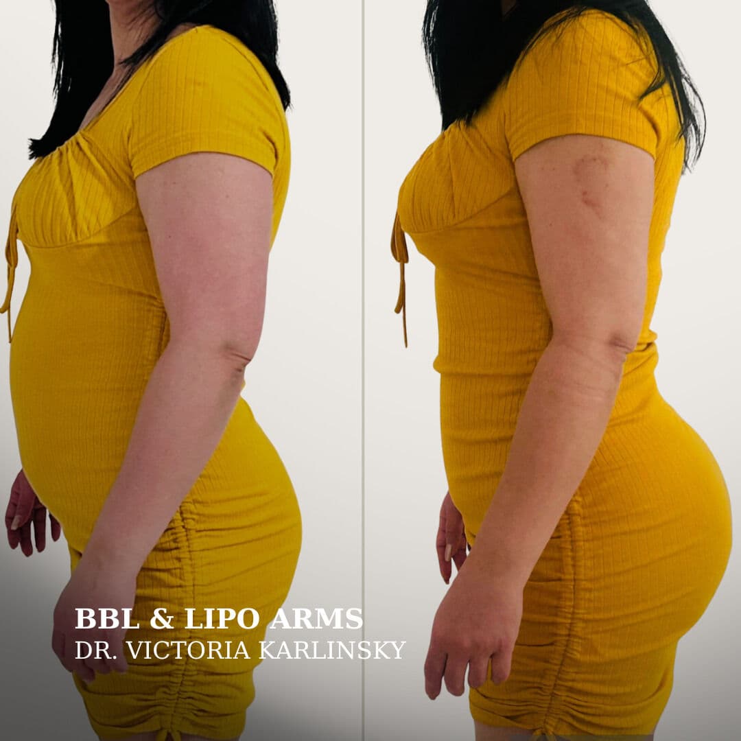 Side-by-side before and after images of a woman in a yellow dress, showing enhanced curves, a flatter abdomen, and slimmer arms following a Brazilian butt lift and arm liposuction, profile view