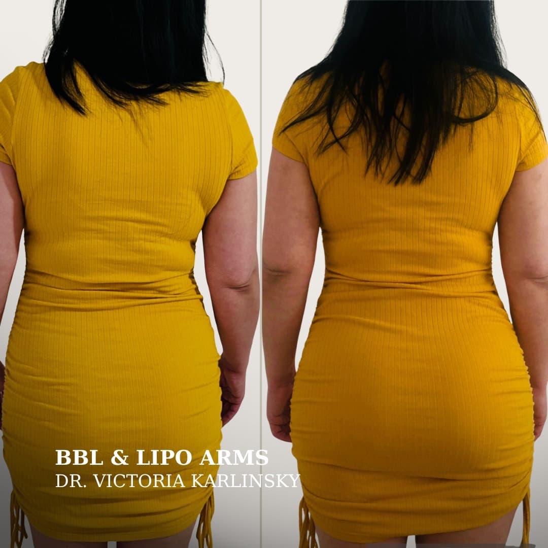 Side-by-side before and after images of a woman in a yellow dress, showing enhanced buttock projection, slimmer arms, and a more defined waist and hip contour after BBL and arm liposuction procedures.
