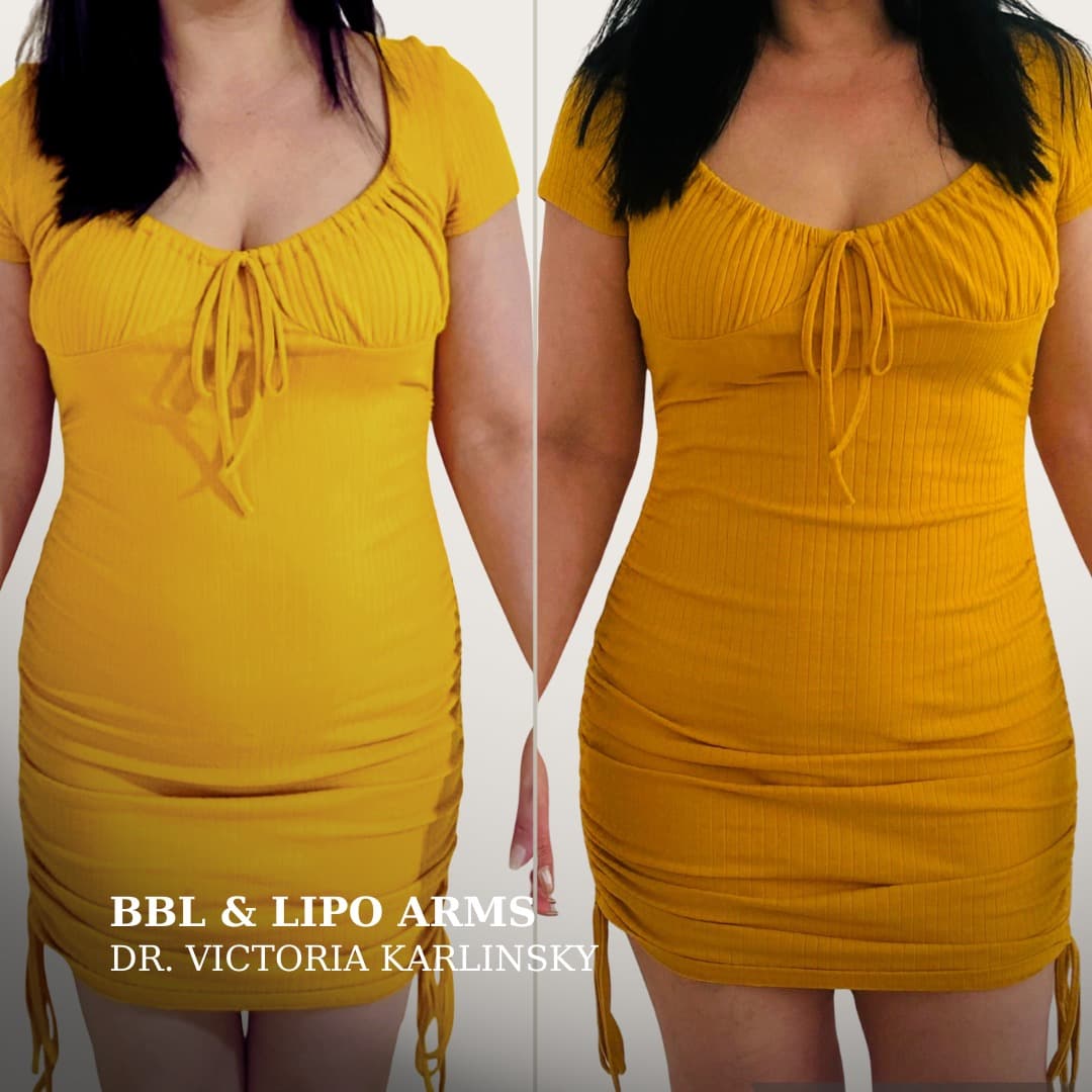 Side-by-side before and after photos of a woman in a yellow dress showing slimmer arms and a more contoured waist following arm liposuction and a Brazilian Butt Lift, front view