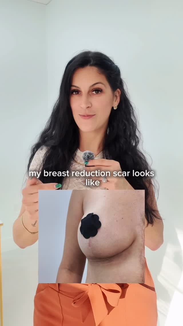 One of the biggest fears before surgery? Scars.
One of the biggest surprises after surgery with Dr. 