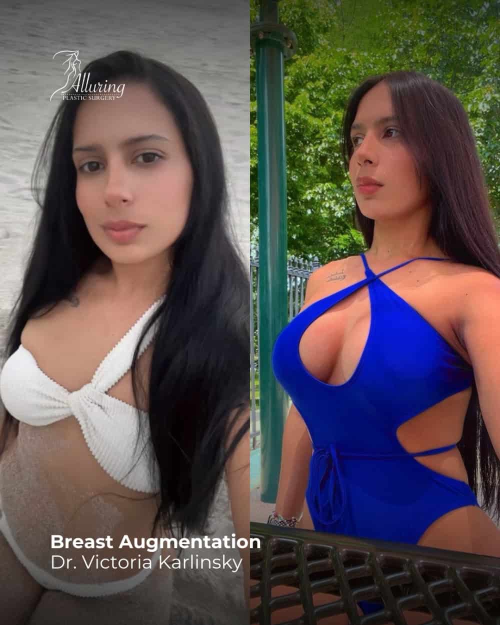 Breast Augmentation