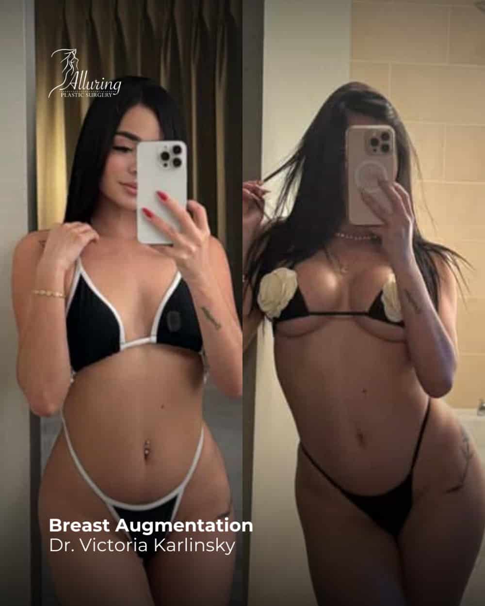 Breast Augmentation
