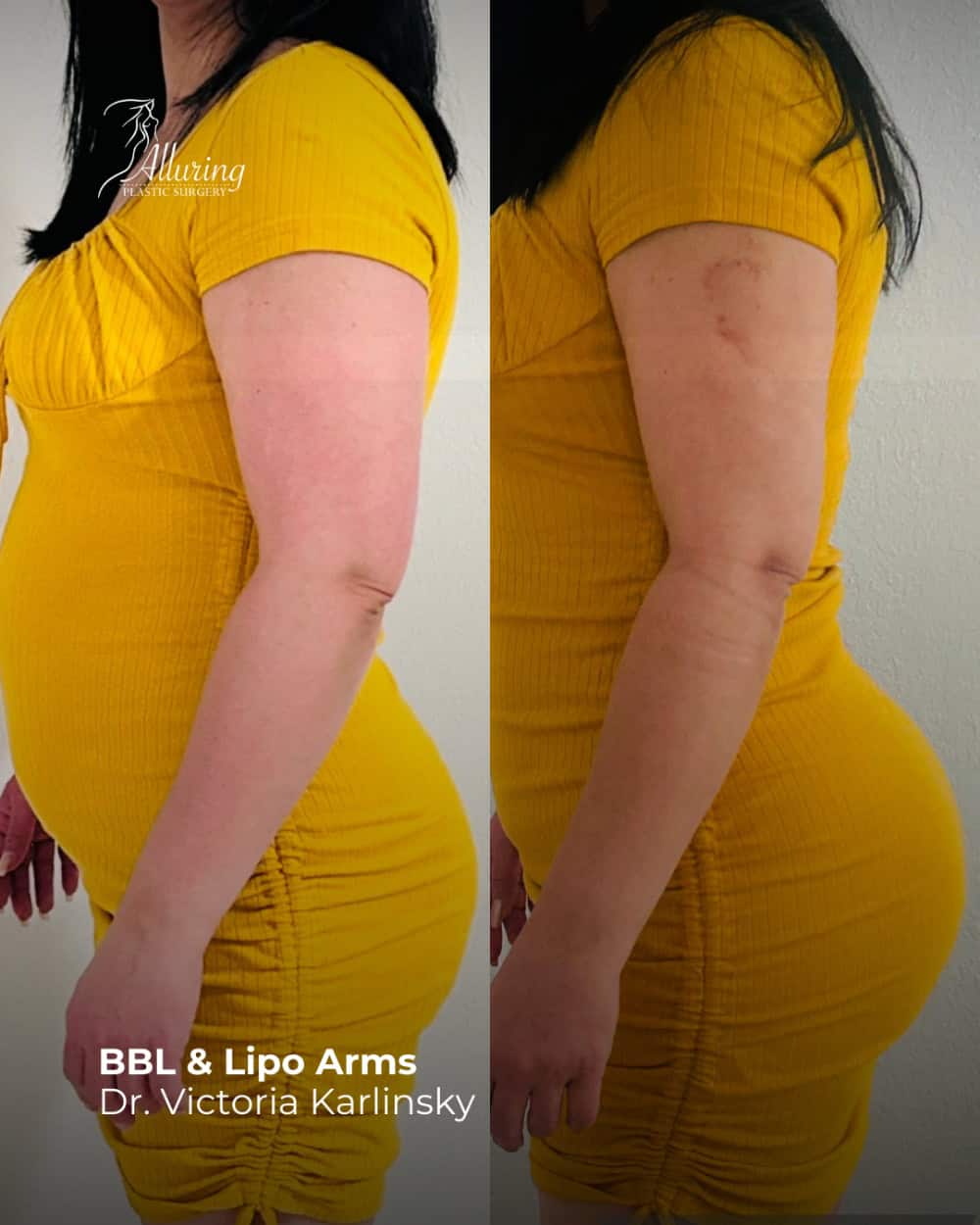 BBL & Arm Lipo
