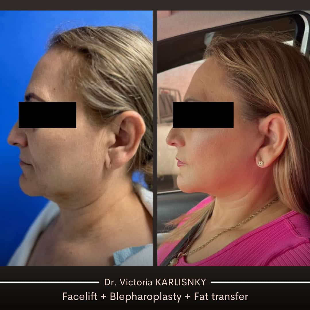 Side-by-side before and after images of a woman's profile showing improved jawline, smoother neck, and fuller midface following facelift, blepharoplasty, and fat transfer procedures; eyes are covered for privacy.