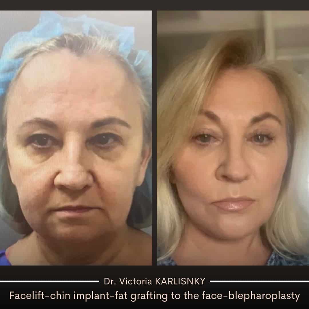 Side-by-side before and after images showing a female patient's facelift transformation, with improved jawline, fuller cheeks, and smoother facial skin, photographed from the front.