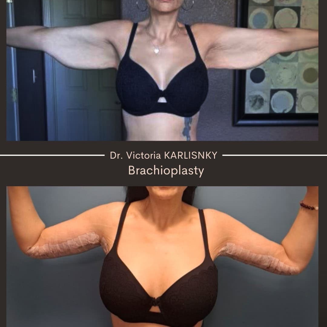 Before and after brachioplasty results showing a woman's arms extended to the sides, with reduced upper arm skin laxity and improved contour in the post-operative image.