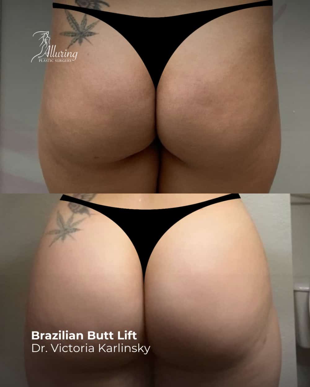 Side-by-side before and after photos showing a posterior view of a female patient’s buttocks and upper thighs following a Brazilian Butt Lift, highlighting increased projection, roundness, and improved contour.