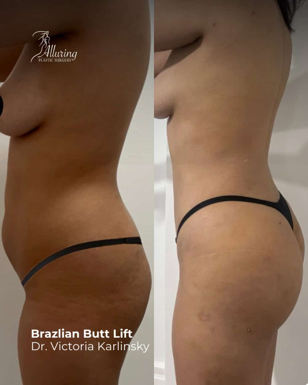 Side-by-side before and after photos showing a woman's torso, buttocks, and upper thigh following a Brazilian Butt Lift, with noticeable increased roundness and improved waist-to-hip ratio in the postoperative image