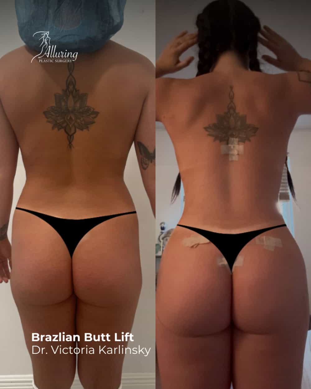 Side-by-side before and after images of a woman’s back, highlighting enhanced buttock projection and roundness following a Brazilian Butt Lift, with surgical tapes visible and tattoos used for anatomical reference.