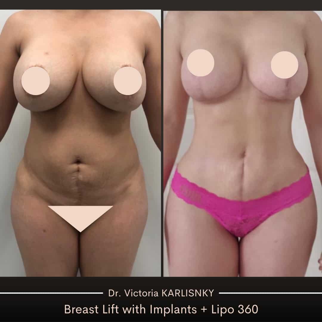 Side-by-side before and after of a woman following breast lift with implants and 360 liposuction, showing elevated breasts and a more contoured waist and abdomen, front-facing view