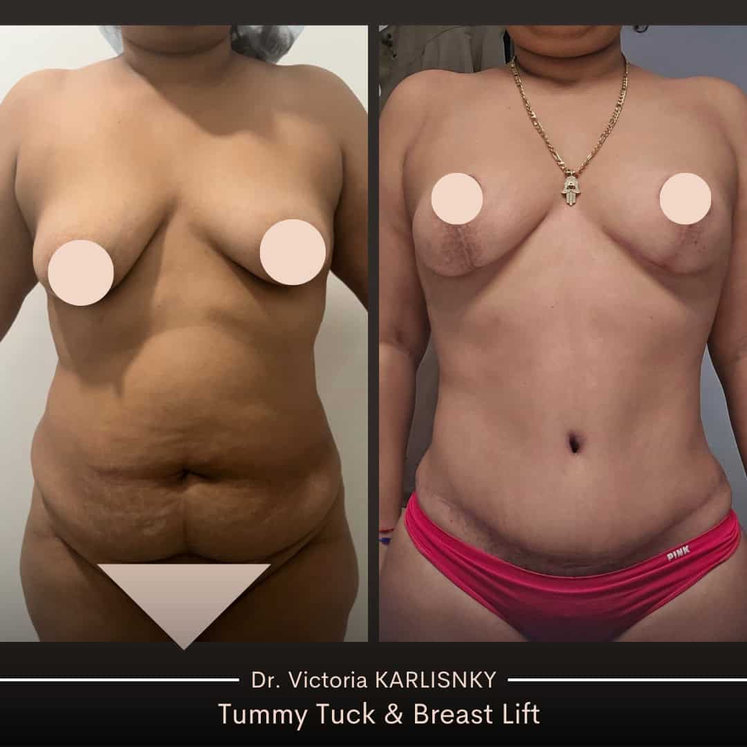 Side-by-side before and after images of a woman’s torso following a mommy makeover, showing a flatter abdomen and elevated, more symmetrical breasts, with surgical scars faintly visible and nipples censored for privacy.