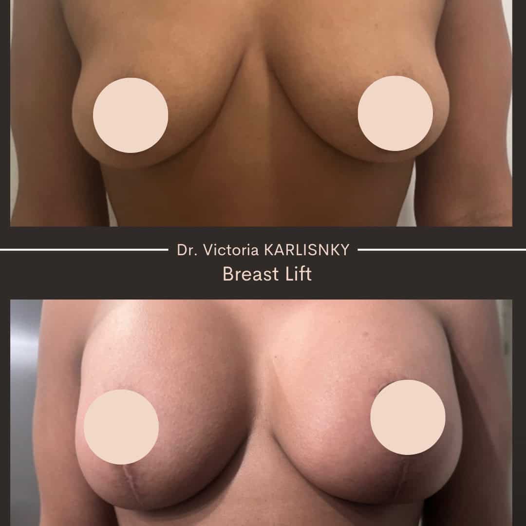 Before and after breast lift images showing elevated, firmer breasts with improved contour and well-healed incisions, chest area only and patient privacy maintained
