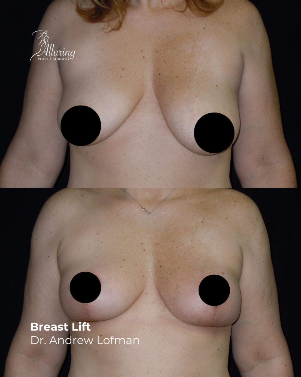 Side-by-side before and after images of a woman’s breasts showing improvement in position, firmness, and symmetry following a breast lift procedure, with faint incision lines beneath the areola.