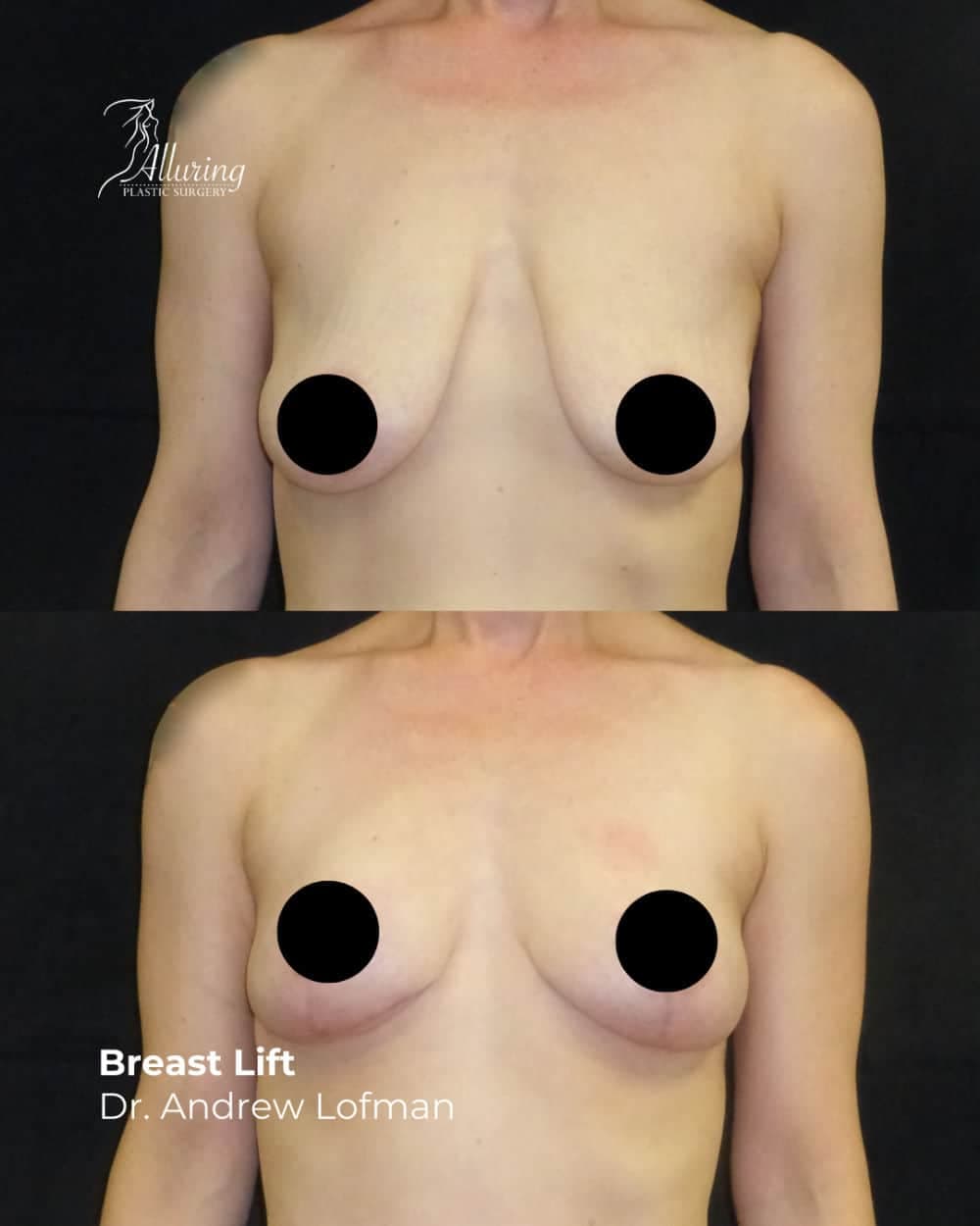 Side-by-side clinical images showing before and after breast lift results, with elevated breast position and improved contour in the front-facing view; nipples are censored for privacy.