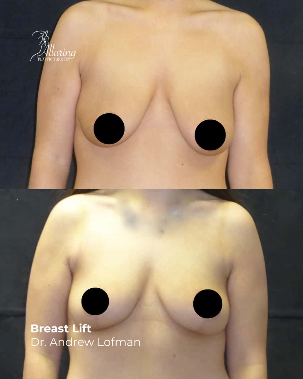 Side-by-side before and after images of a woman's chest showing a noticeable improvement in breast position and contour following a breast lift, with arms at her sides and nipples censored for privacy.