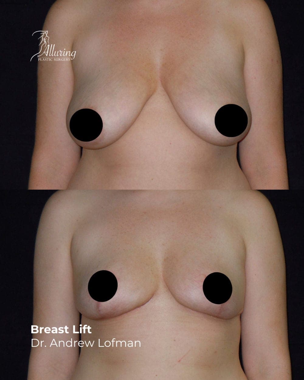 alluring plastic surgery breast lift lofman 05