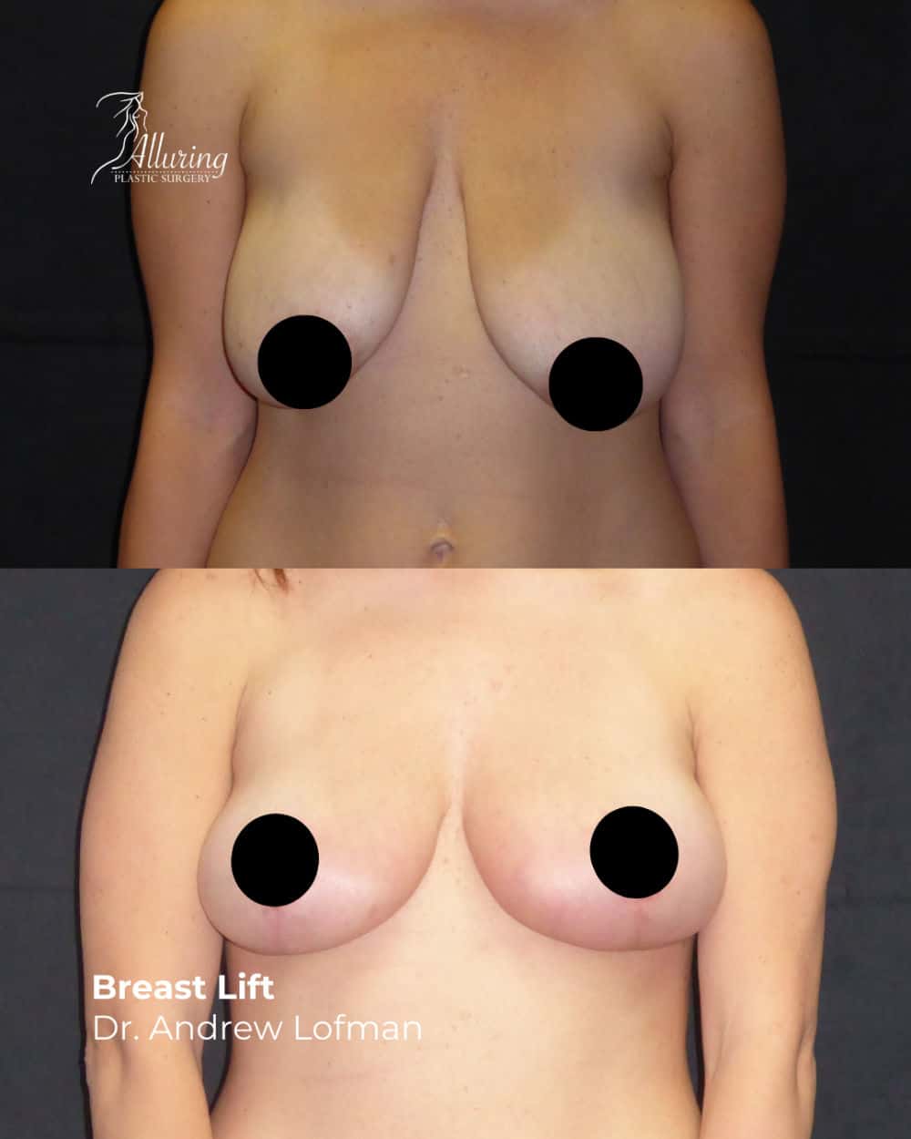Side-by-side before and after breast lift results showing improved breast position, firmness, and elevated nipples from a frontal view