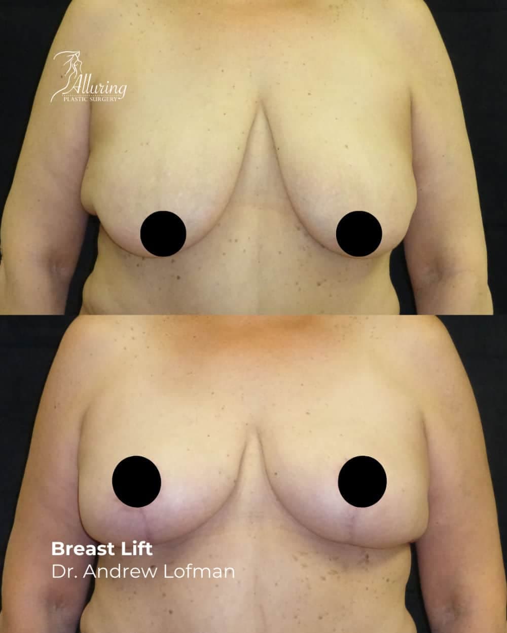 Side-by-side before and after images of a woman's torso showing the results of a breast lift, with elevated and firmer breasts and improved nipple position, frontal view.