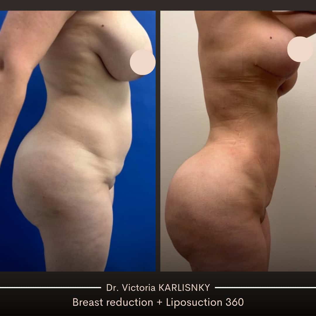 Side-by-side before and after photos showing a female patient's profile view with reduced breast size and a more contoured abdomen and flanks after breast reduction and 360-degree liposuction, nipples concealed for privacy.