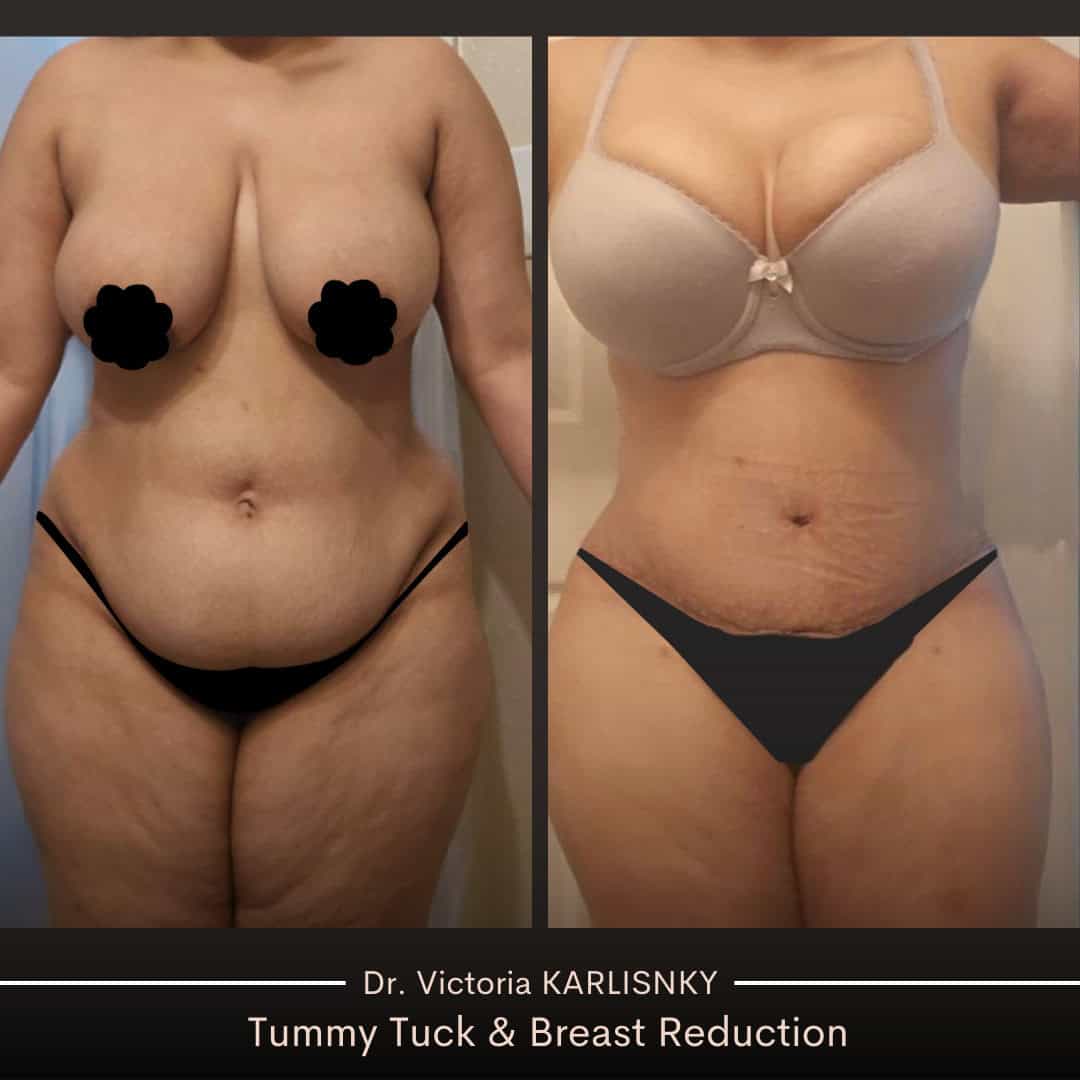 Before and after photo showing a woman's front view results from a mommy makeover, including a tummy tuck and breast reduction, with a flatter abdomen and smaller, lifted breasts.