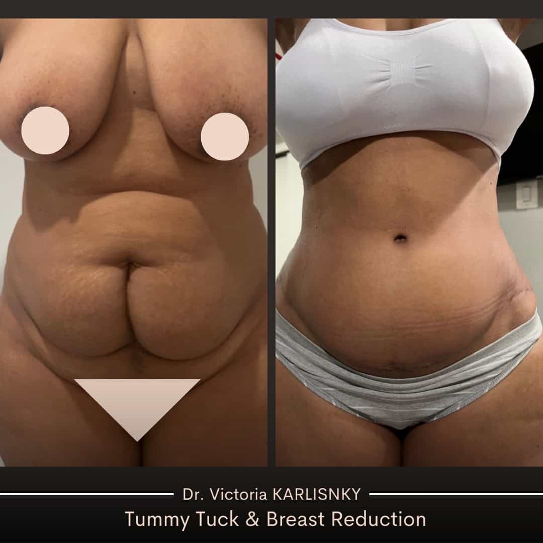 Before and after side-by-side images showing a woman's tummy tuck and breast reduction results, with a flatter abdomen and reduced, lifted breasts, front view