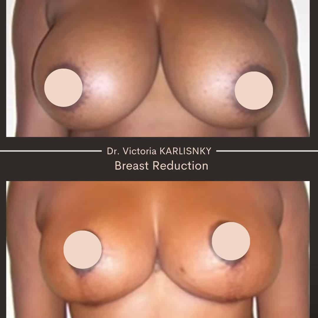 Side-by-side before and after photos of a woman's chest showing the results of breast reduction surgery, with smaller, more proportionate breasts and healed incisions visible.