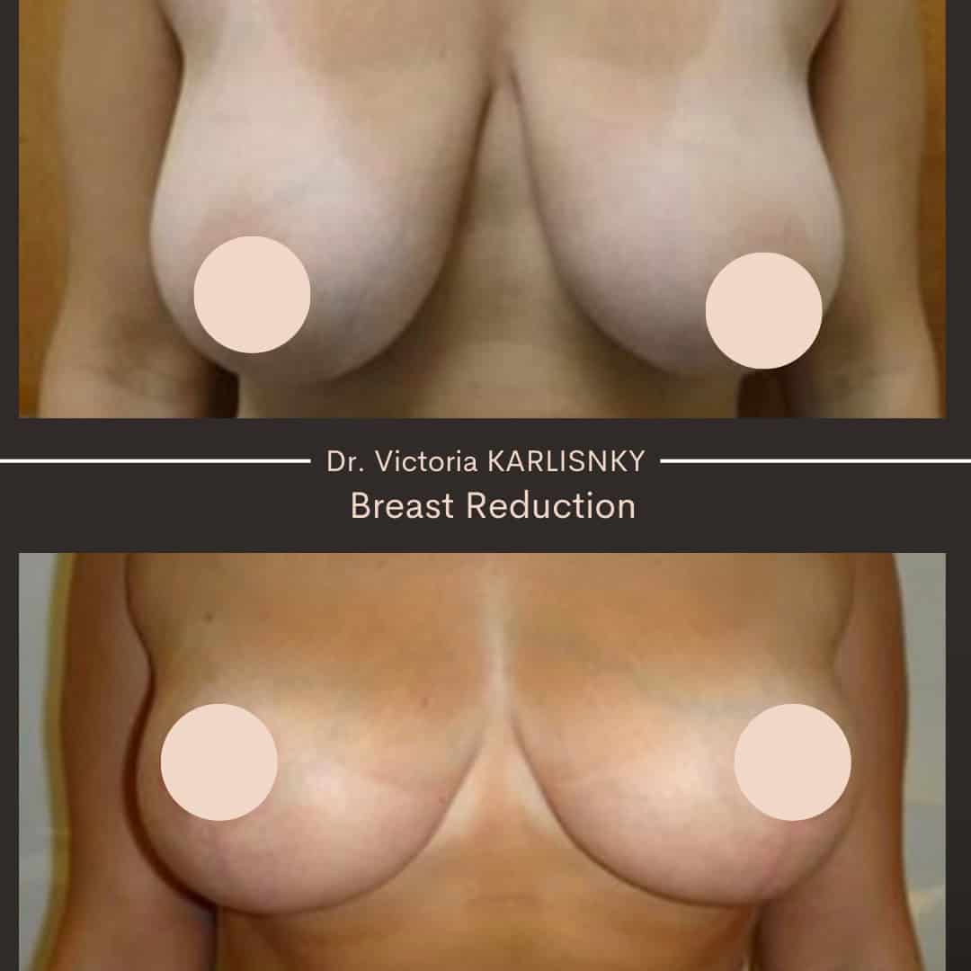 Frontal before-and-after images of a woman's chest showing smaller, lifted, and more proportionate breasts following breast reduction surgery, with nipples censored for privacy.