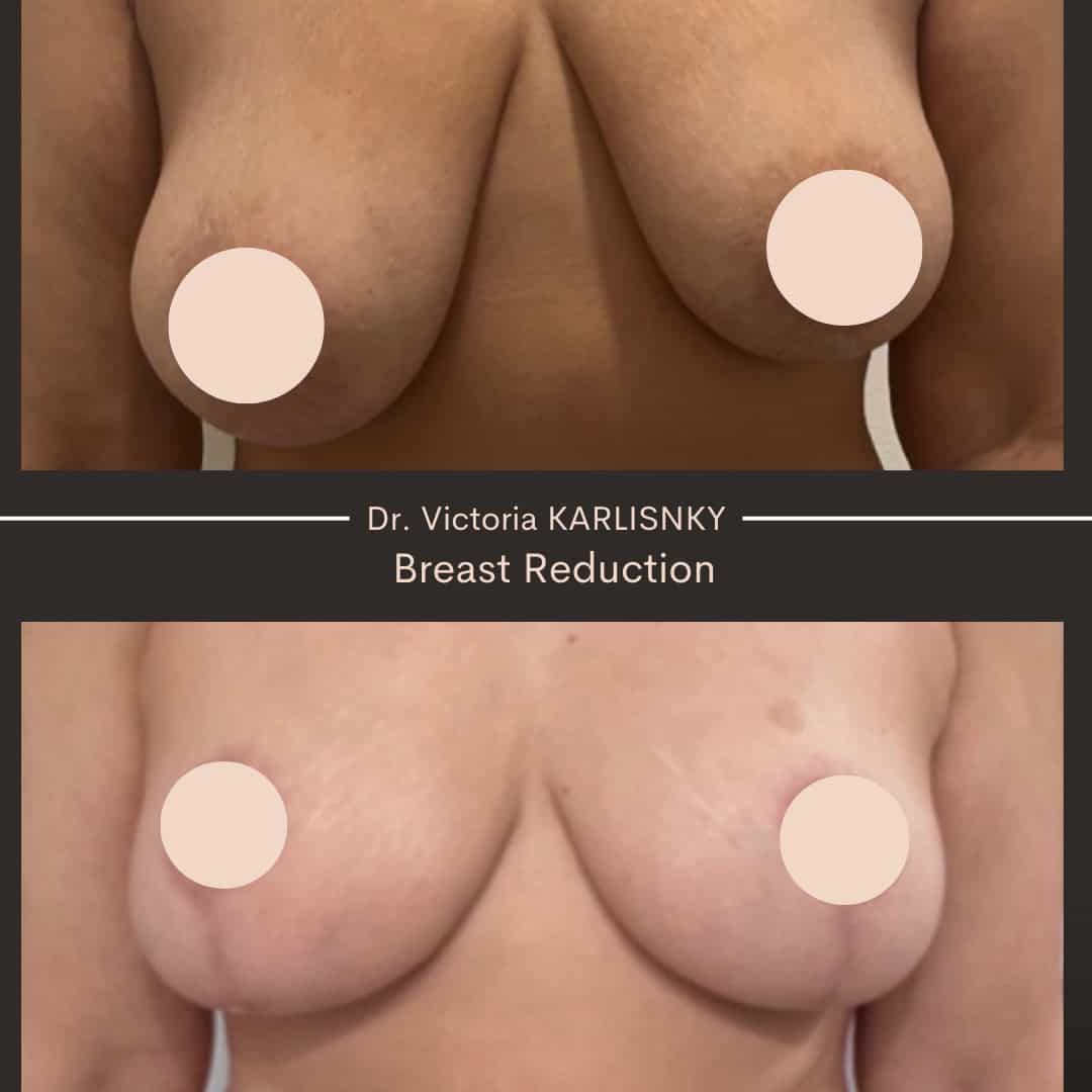Side-by-side before and after breast reduction showing reduced size, lifted breast position, and improved contour, frontal view with nipples and areolae obscured for privacy