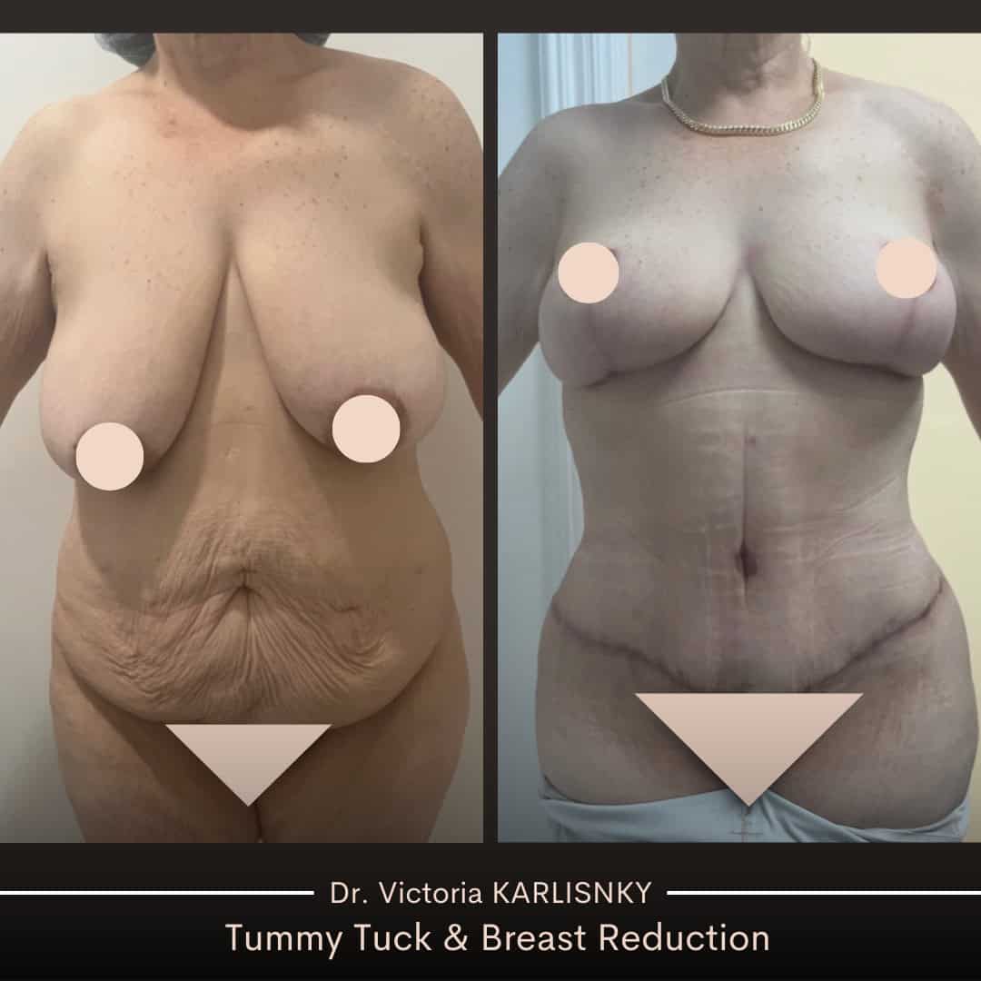 Side-by-side before and after images showing a woman's results from a Mommy Makeover, with breast reduction and lift as well as tummy tuck, highlighting improved breast shape, symmetry, and a flatter, smoother abdomen.