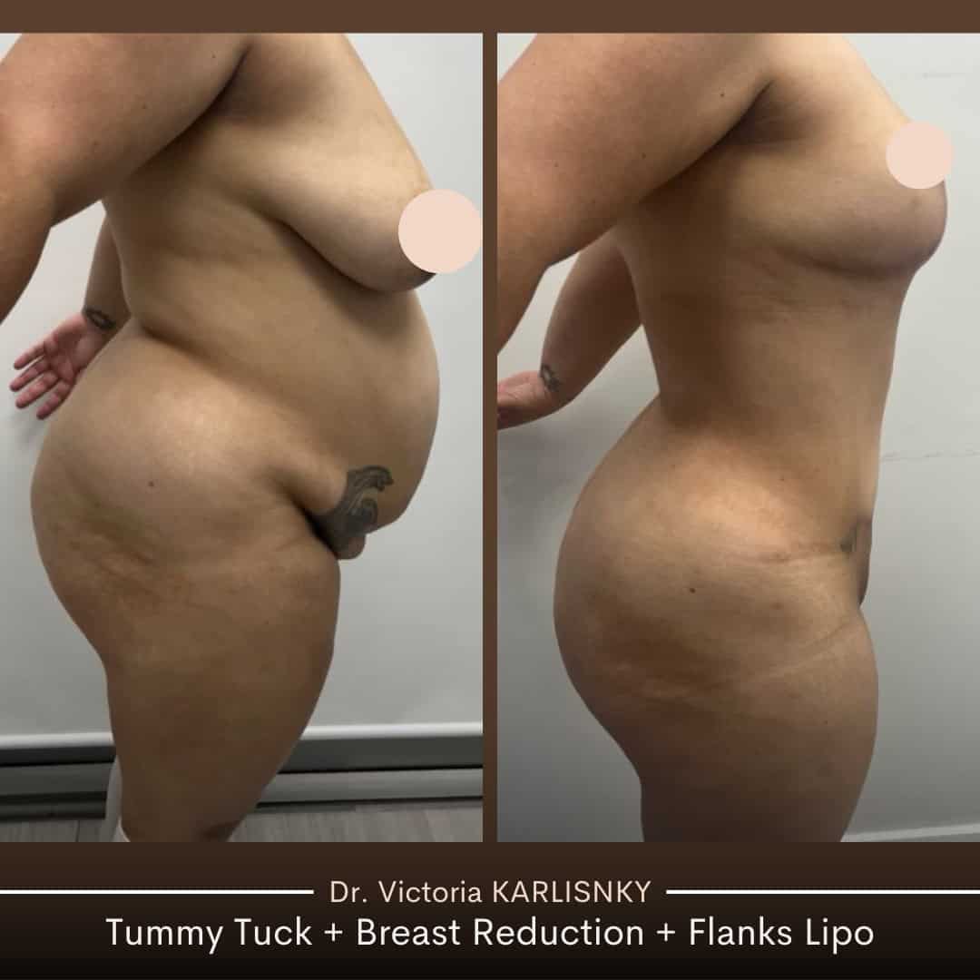 Side-by-side before and after images showing a woman’s side profile transformation following a mommy makeover, including tummy tuck, breast reduction, and liposuction, highlighting a flatter abdomen, reduced breast size, and slimmer waistline.