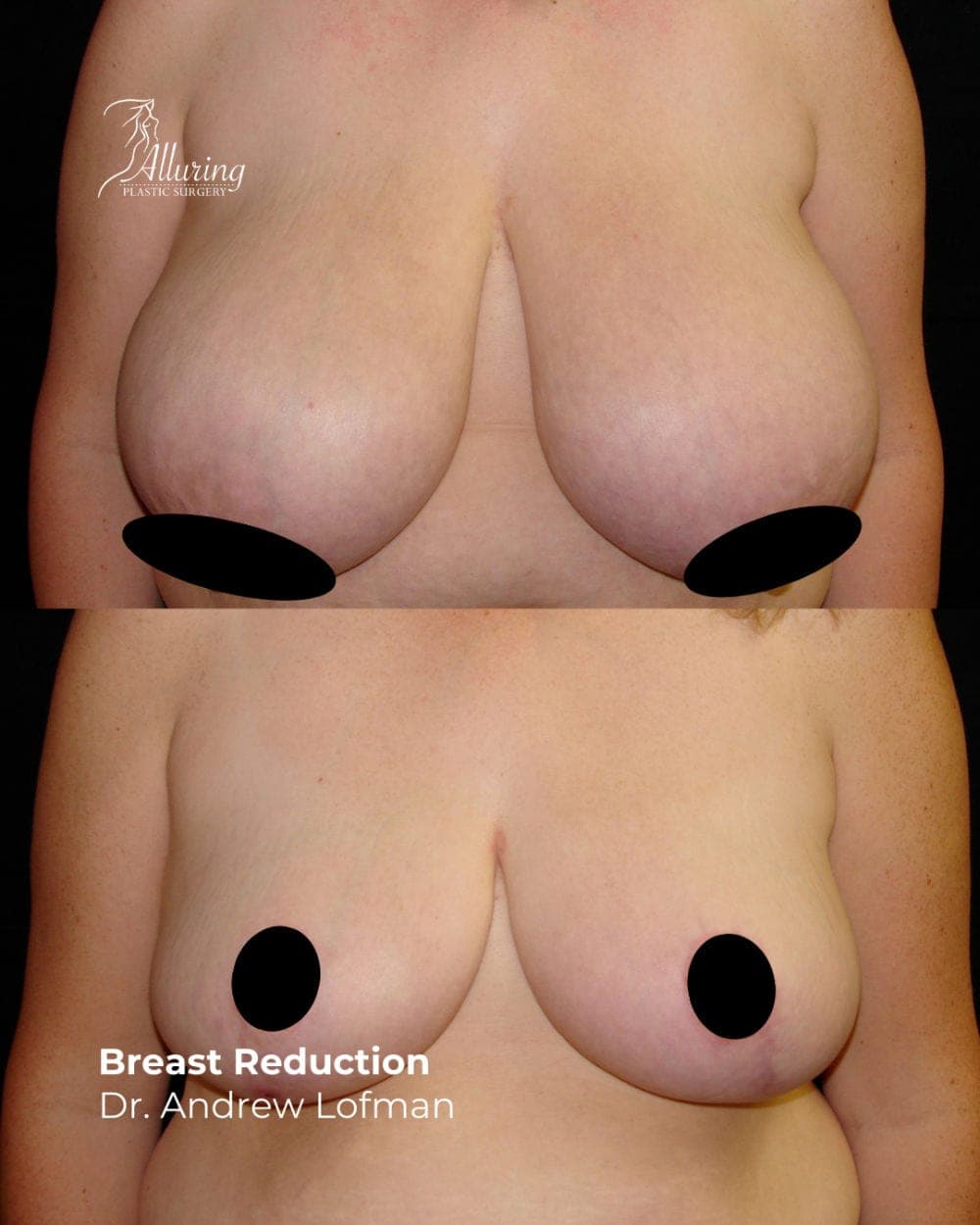 Before and after breast reduction results showing significant decrease in breast size, improved contour, and elevated breast position, front view