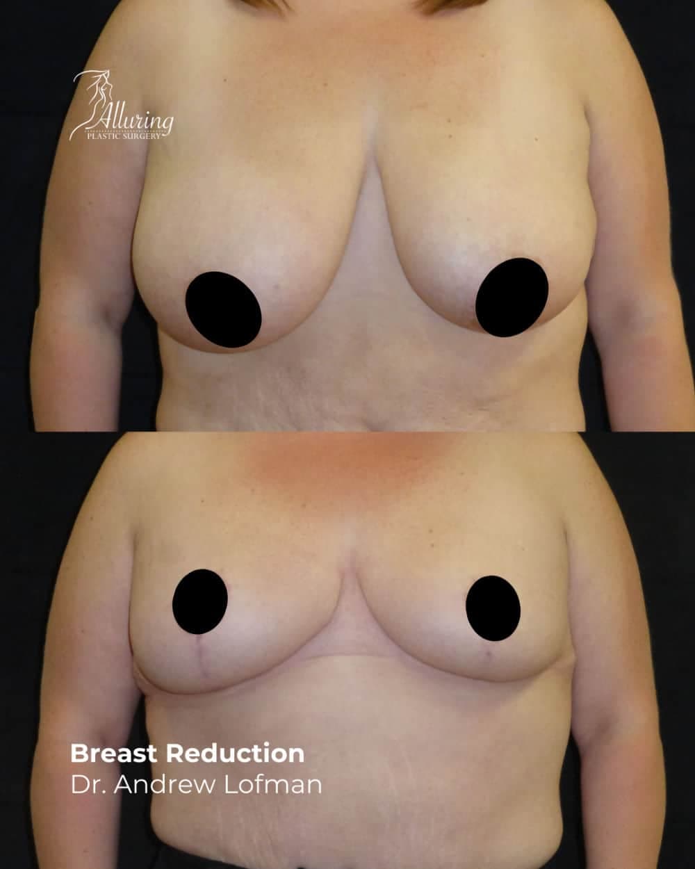 Before and after breast reduction results, front view showing smaller, lifted breasts with improved contour and symmetry