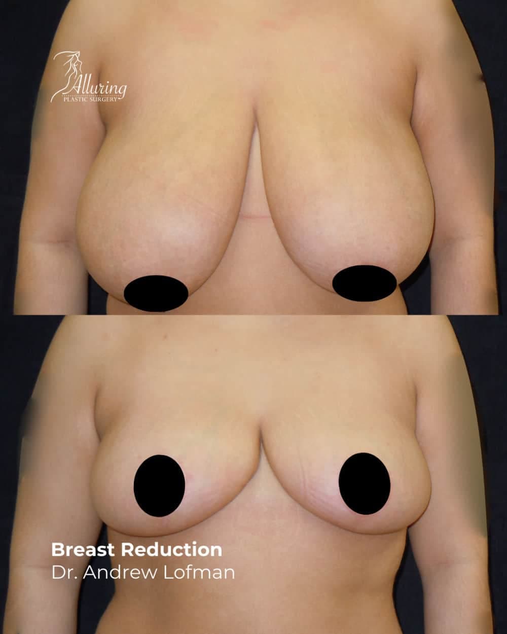 Side-by-side before and after images of a woman's upper torso showing significant reduction in breast size and improved breast contour following breast reduction surgery, front view.
