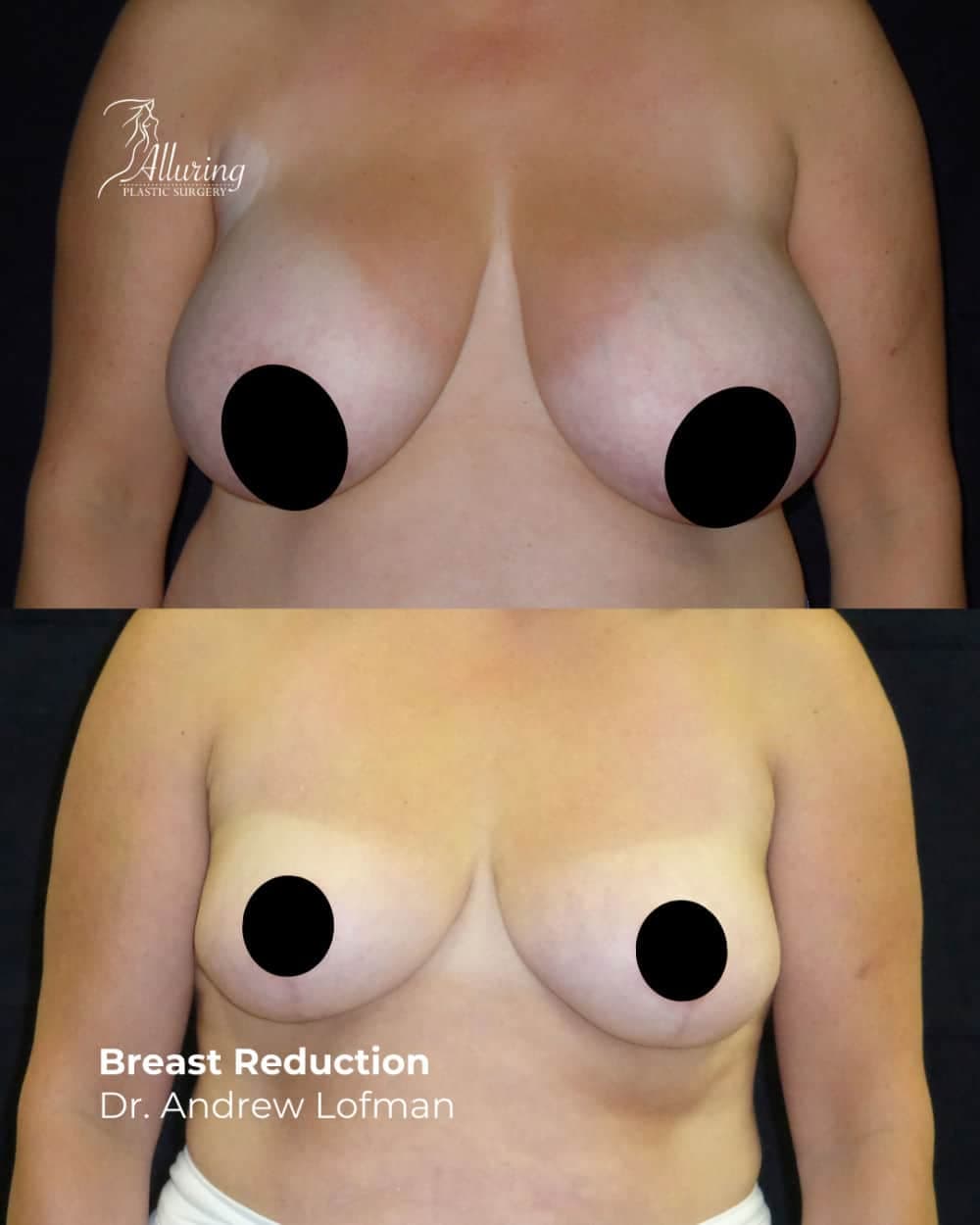 Side-by-side before and after images of a breast reduction, showing reduced breast volume, elevated positioning, and improved symmetry on a female patient's chest and upper torso, front view, nipples censored for privacy.