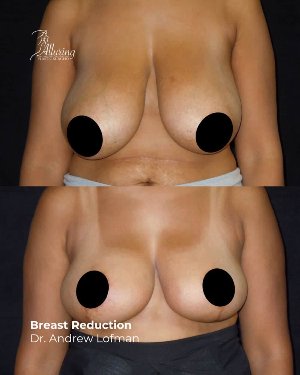 Before and after breast reduction results showing smaller, lifted breasts with improved shape and symmetry, front view, nipples censored for privacy