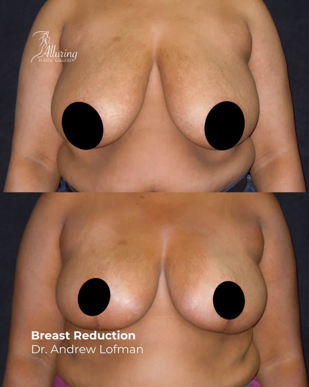 Side-by-side before and after images of a woman’s upper torso, showing smaller, elevated, and more symmetrical breasts following breast reduction surgery. Nipples are censored for privacy.