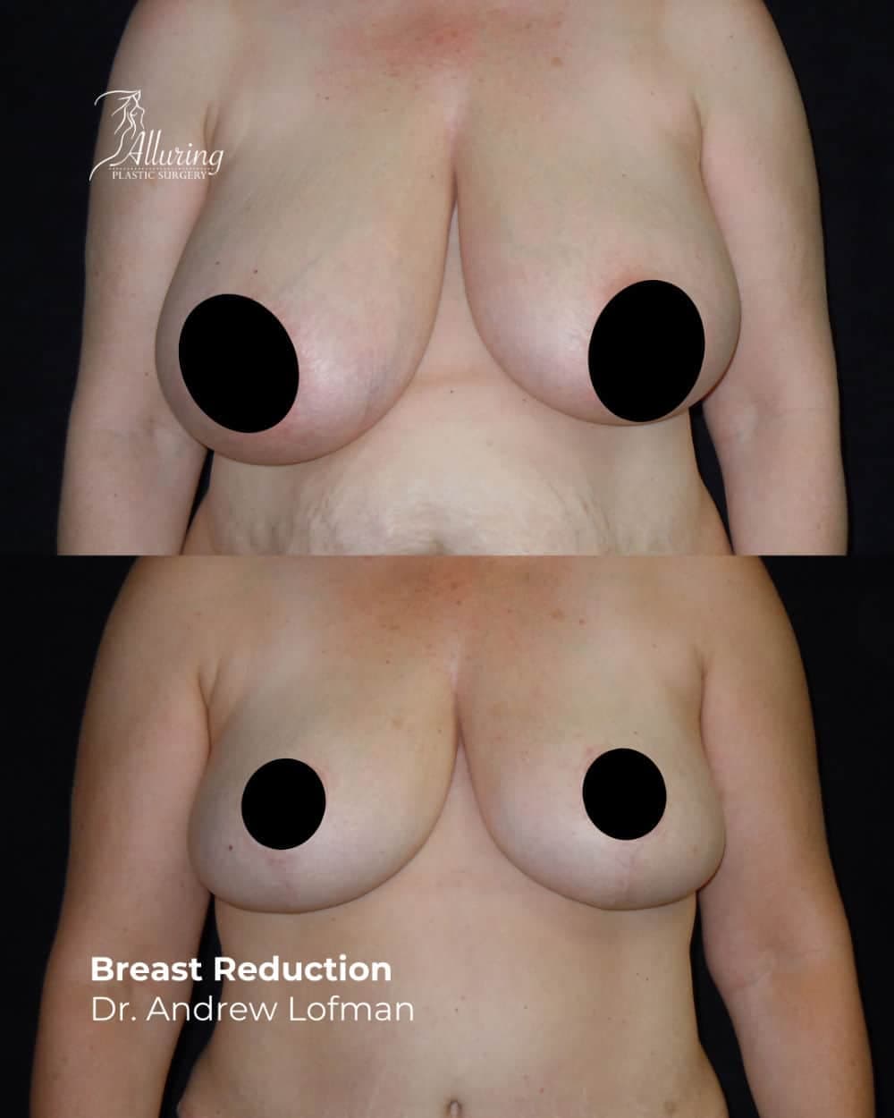 Before and after breast reduction results, front view showing reduced breast volume, lifted and more symmetrical breasts, with nipples positioned higher and incision lines subtly visible