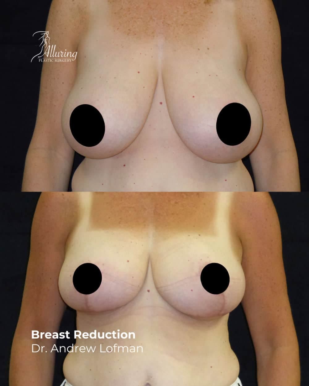 Before and after breast reduction results showing smaller, lifted, and more symmetrical breasts with healed incision lines, front view