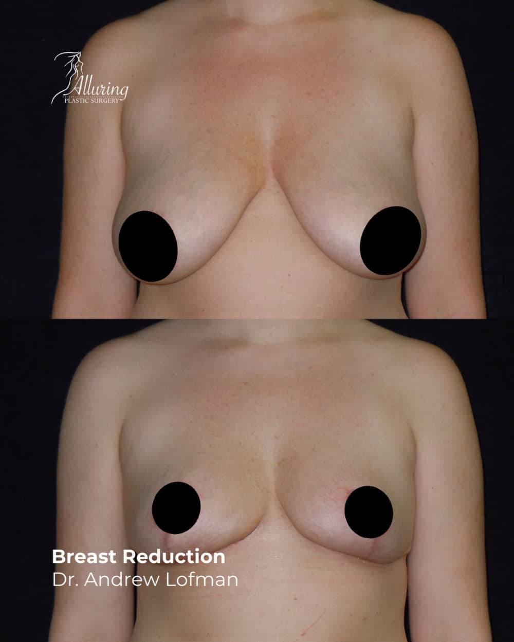 Side-by-side before and after images of a woman's chest showing breast reduction results—smaller, uplifted breasts with improved contour and elevated nipple position