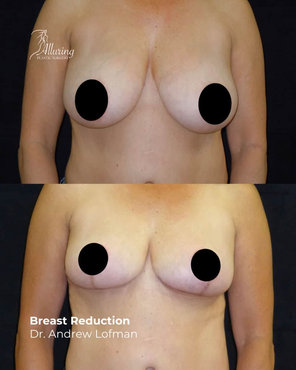 Before and after breast reduction results showing smaller, uplifted breasts with improved contour, front view, privacy maintained