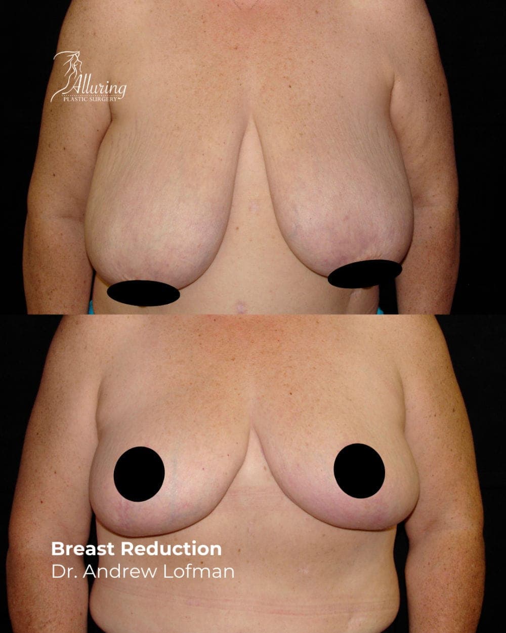 alluring plastic surgery breast reduction lofman 12