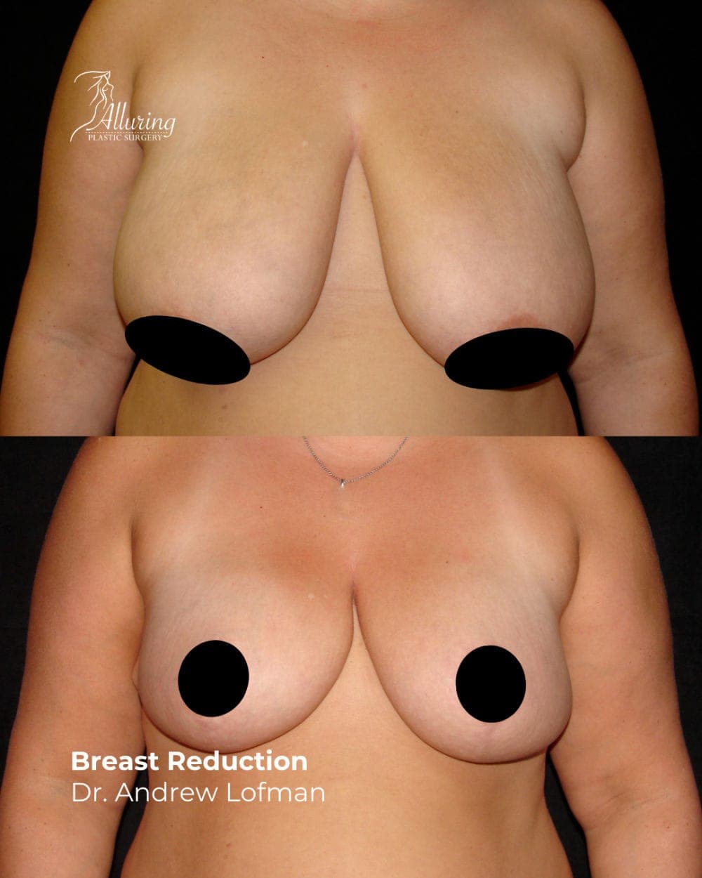 Side-by-side before and after images of a woman's torso showing breast reduction results from a frontal view; breasts appear smaller, lifted, and more symmetrical after surgery.